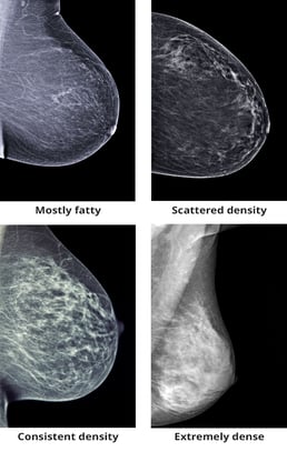 example of dense and fatty breasts - breast density comparison