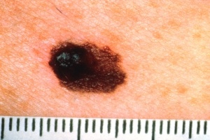 A for Asymmetry | Asymmetrical Skin Cancer