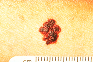 B for Border | Skin Cancer Irregular Border