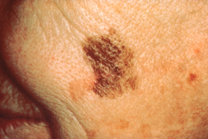 D for Diameter of Skin Cancer