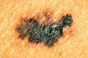 C for Color | color of skin cancer